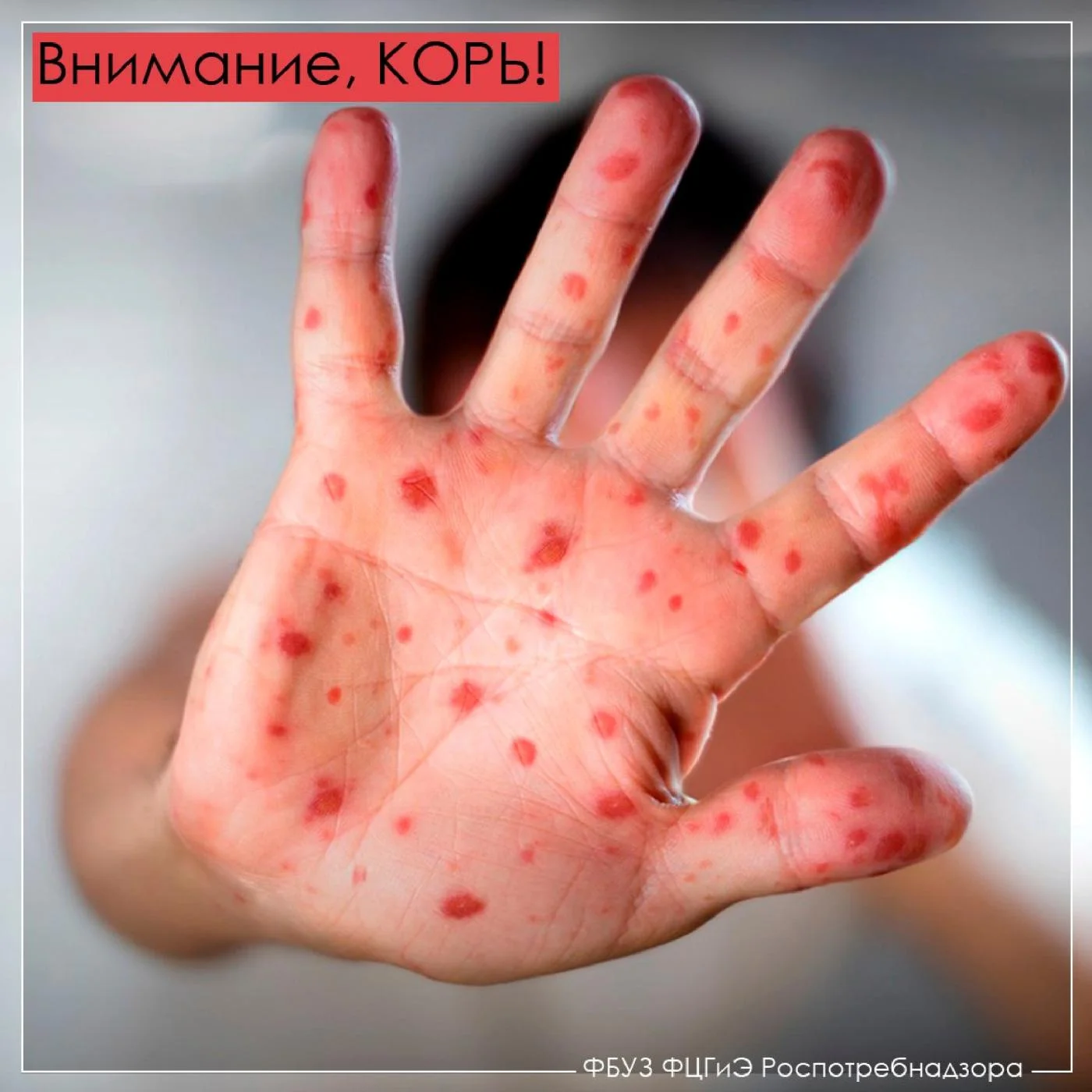 Профилактика кори