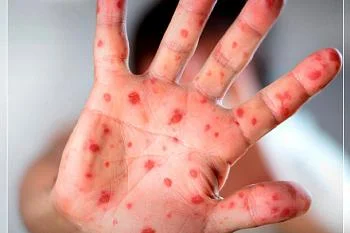 Профилактика кори